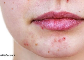 Benzoyl Peroxide or Tea Tree Oil for Acne?