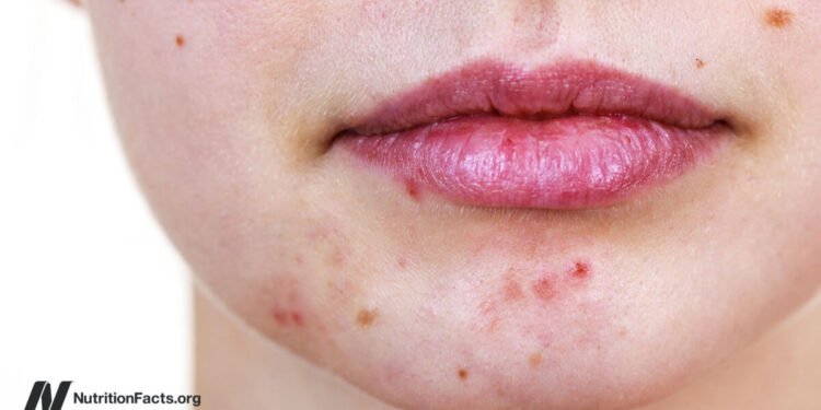 Benzoyl Peroxide or Tea Tree Oil for Acne?