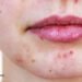 Benzoyl Peroxide or Tea Tree Oil for Acne?