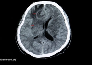 Toxoplasmosis and Schizophrenia 