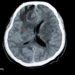 Toxoplasmosis and Schizophrenia 