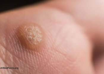 Should We Remove Warts with Duct Tape? 