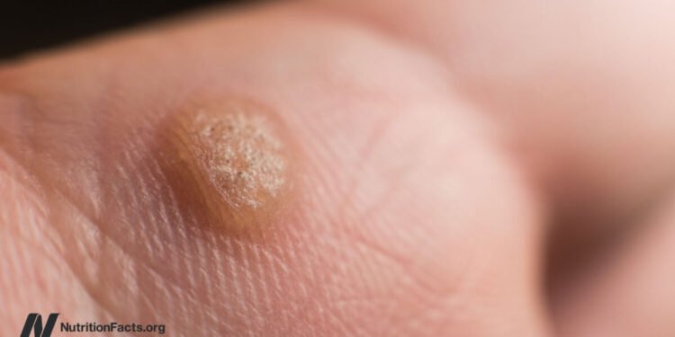 Should We Remove Warts with Duct Tape? 