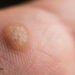 Should We Remove Warts with Duct Tape? 