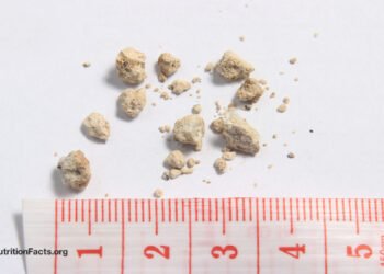 High Oxalate Greens and Kidney Stones 