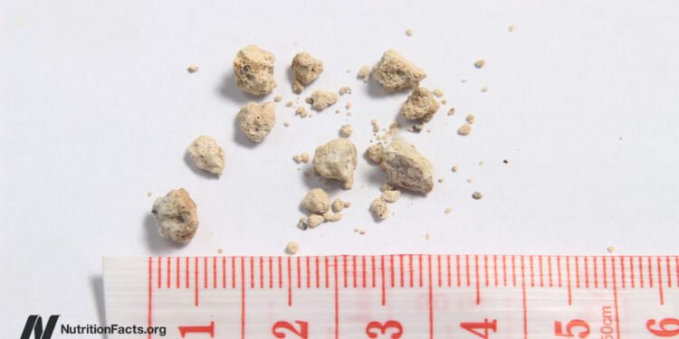 High Oxalate Greens and Kidney Stones 