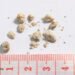 High Oxalate Greens and Kidney Stones 