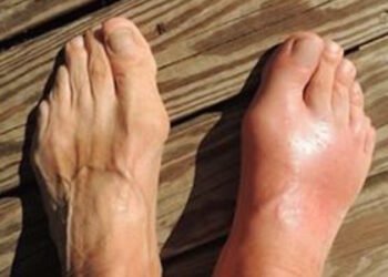 Remove uric acid from your body and reduce joint pain