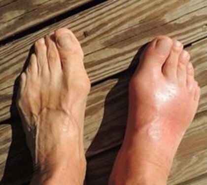 Remove uric acid from your body and reduce joint pain
