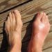 Remove uric acid from your body and reduce joint pain