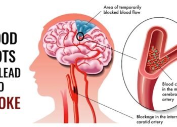 Natural Blood Thinners To Reduce Blood Clots And Risk of Stroke