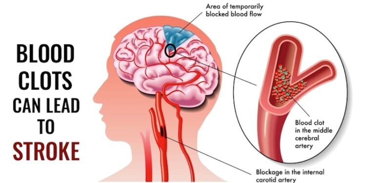 Natural Blood Thinners To Reduce Blood Clots And Risk of Stroke