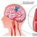 Natural Blood Thinners To Reduce Blood Clots And Risk of Stroke