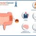 Experts warn about the rising rates of colon cancer in young people