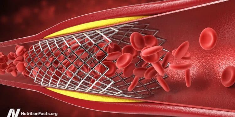 The Truth About Heart Stents