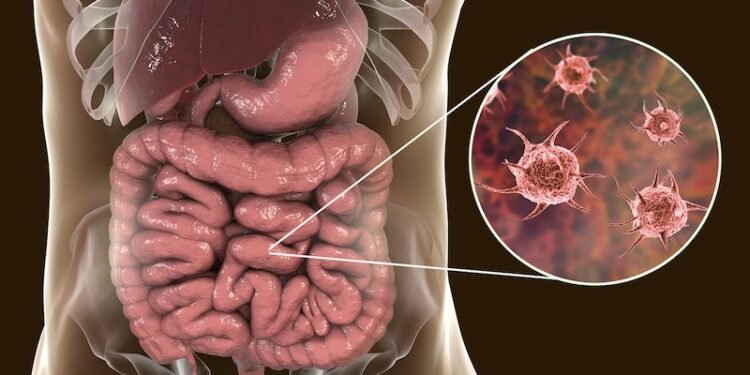 Parasite Cleanse – How To Completely Kill 100+ Types of Parasite