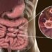 Parasite Cleanse – How To Completely Kill 100+ Types of Parasite