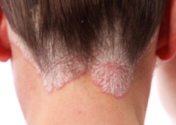 Reverse Psoriasis With Diet And Sulforaphane-Rich Foods