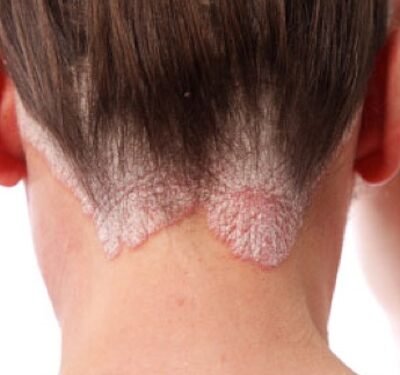Reverse Psoriasis With Diet And Sulforaphane-Rich Foods