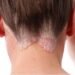 Reverse Psoriasis With Diet And Sulforaphane-Rich Foods