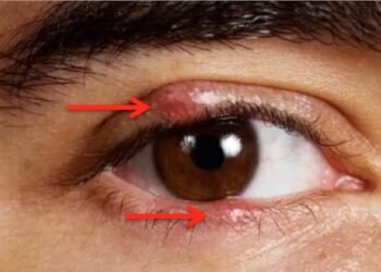 Colloidal Silver Heal Eye Infections Fast