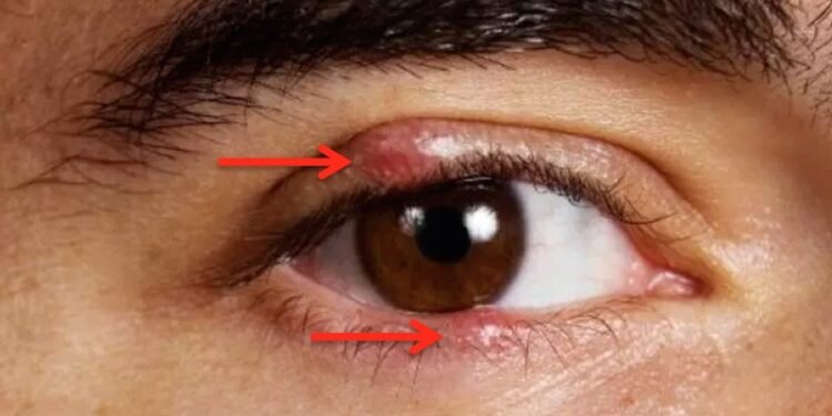 Colloidal Silver Heal Eye Infections Fast