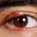 Colloidal Silver Heal Eye Infections Fast