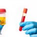 Testing for Vitamin B12 Deficiency 