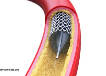 Why Aren’t Angioplasty Heart Stents More Effective? 