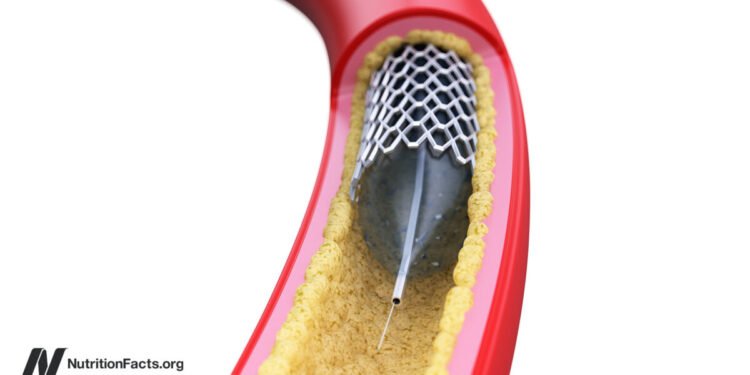 Why Aren’t Angioplasty Heart Stents More Effective? 