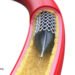 Why Aren’t Angioplasty Heart Stents More Effective? 