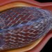 Heart Stents and Their Risks 