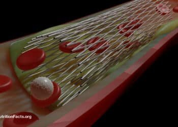 Do Heart Stents Benefit Angina Chest Pain? 