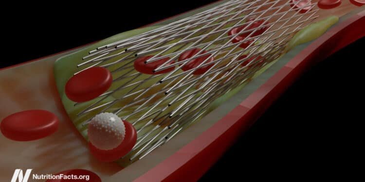 Do Heart Stents Benefit Angina Chest Pain? 
