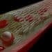 Do Heart Stents Benefit Angina Chest Pain? 