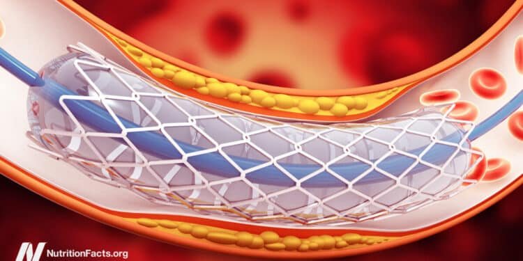 Why Use Stents When They Don’t Work? 