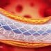 Why Use Stents When They Don’t Work? 