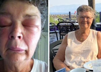 How a WFPB Diet Helped Me Overcome 20 Years of Angioedema