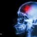 Fasting and Plant-Based Diets for Migraines and Traumatic Brain Injuries 
