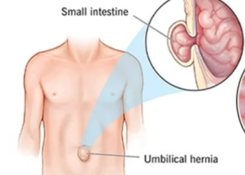 My Journey with Hernia Recovery and Fitness Adaptation – Vegan Muscle and Fitness