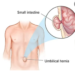My Journey with Hernia Recovery and Fitness Adaptation – Vegan Muscle and Fitness
